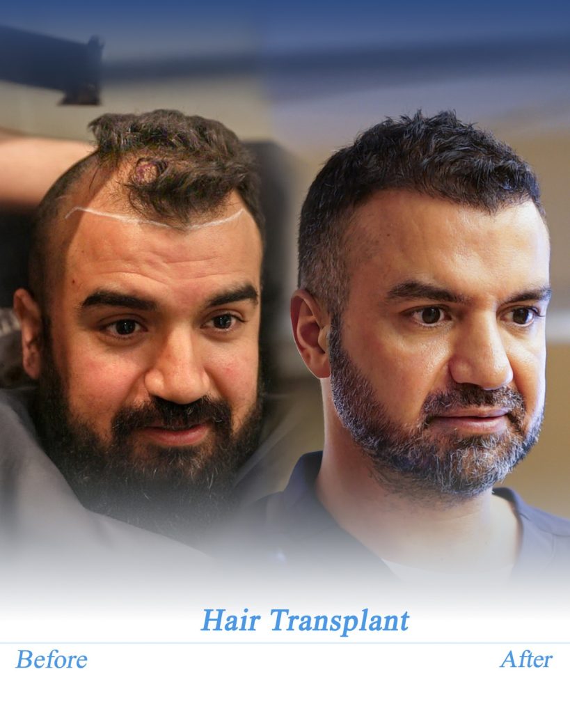 My Journey with Hair Transplantation; Both as a Surgeon and a Patient